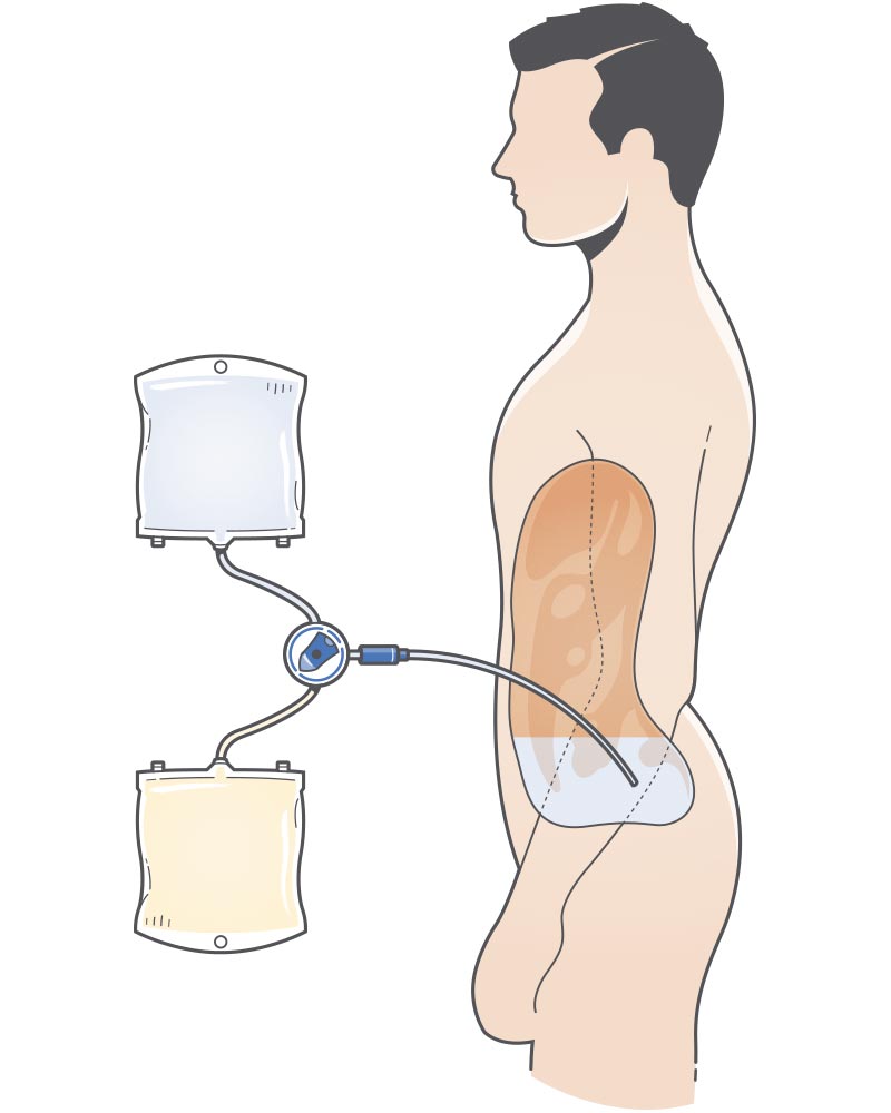 Desenho da diálise peritoneal