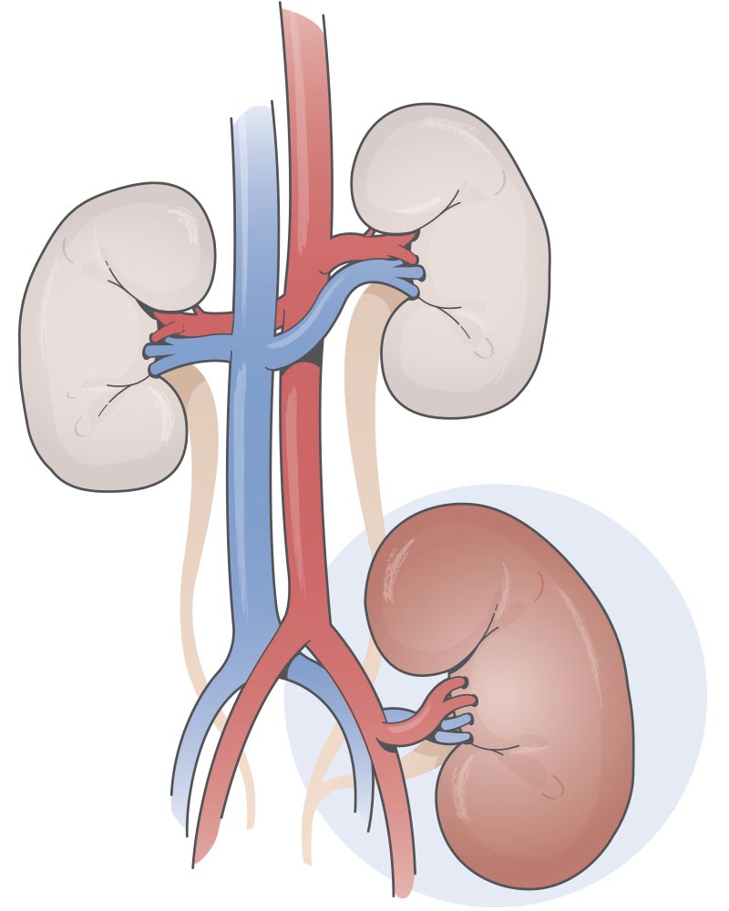 Desenho de um rim transplantado